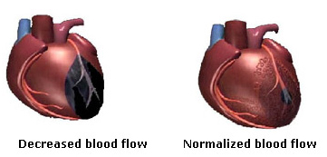 eecp treatment blood flow