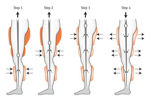 how does eecp treatment work