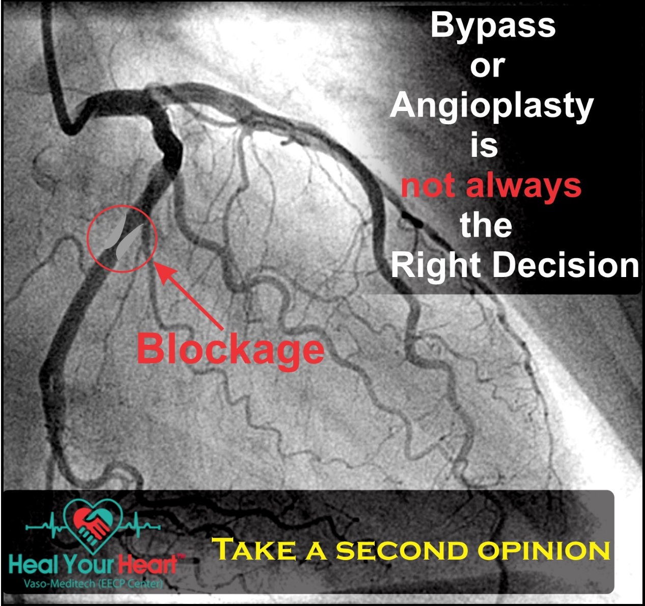 Second EECP Opinion