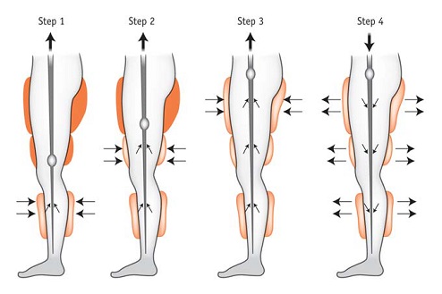 angioplasty treatment chennai tamilnadu