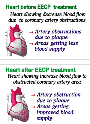 eecp care chennai