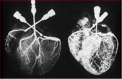 heart blockage treatment chennai