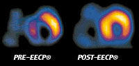 post pre eecp treatment