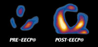 Before eecp eecp treatment vs after eecp treatment