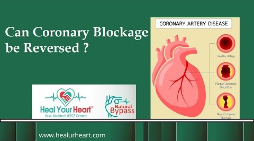 can coronary artery blockage be reversed